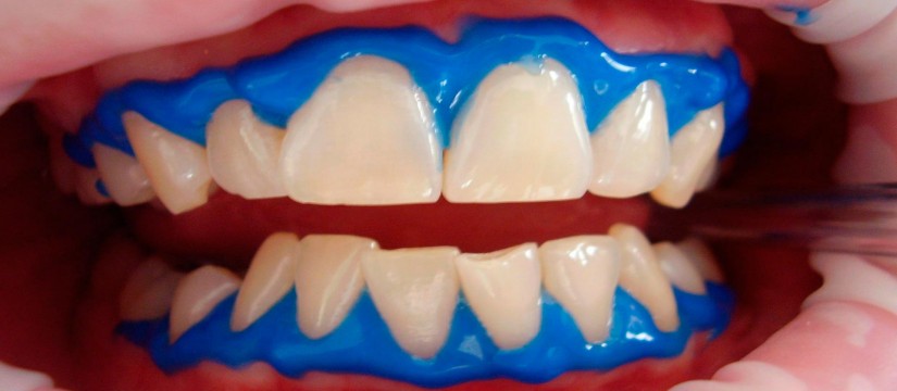 El-blanqueamiento-dental1920