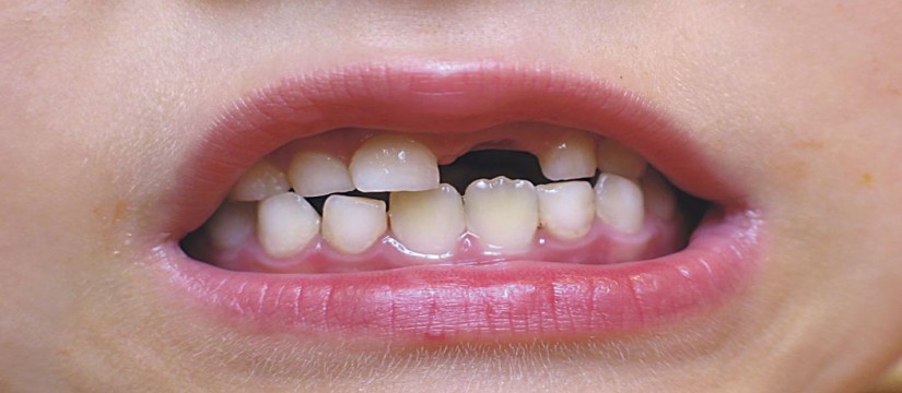Es-necesario-empastar-dientes-y-muelas-de-leche-1920