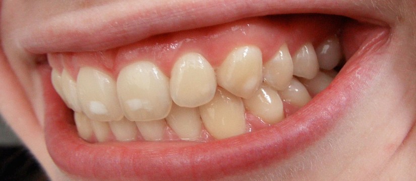 Las-manchas-blancas-en-los-dientes-1920